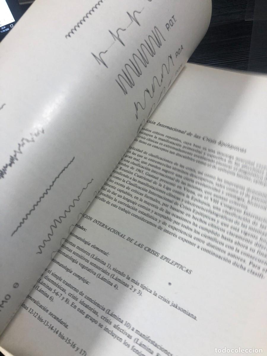 Libros: Atlas elemental de EEG en epilepsias Secci&oacute;n Cient&iacute;fica &rdquo;Roche&rdquo; - Foto 7