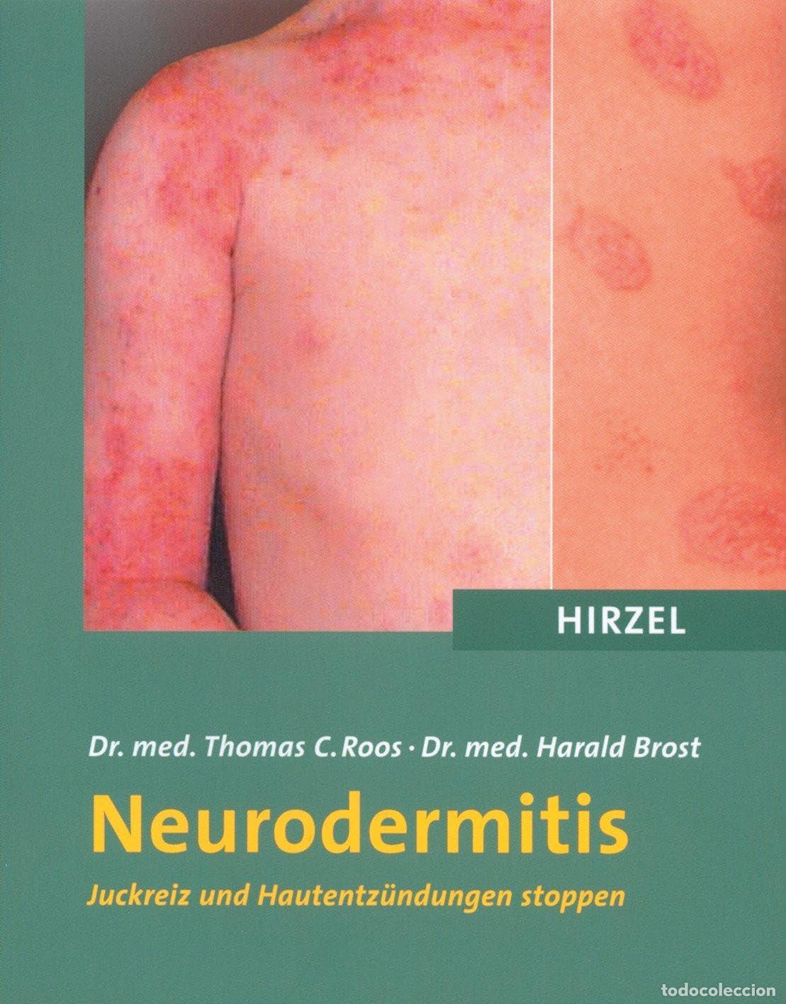 B&uuml;cher: Neurodermitis: Juckreiz und Hautentz&uuml;ndungen stoppen