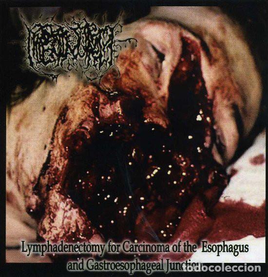 CD de M&uacute;sica: Hipermenorrea -- Lymphadenectomy For Carcinoma Of ..........GRIND CORE GORE