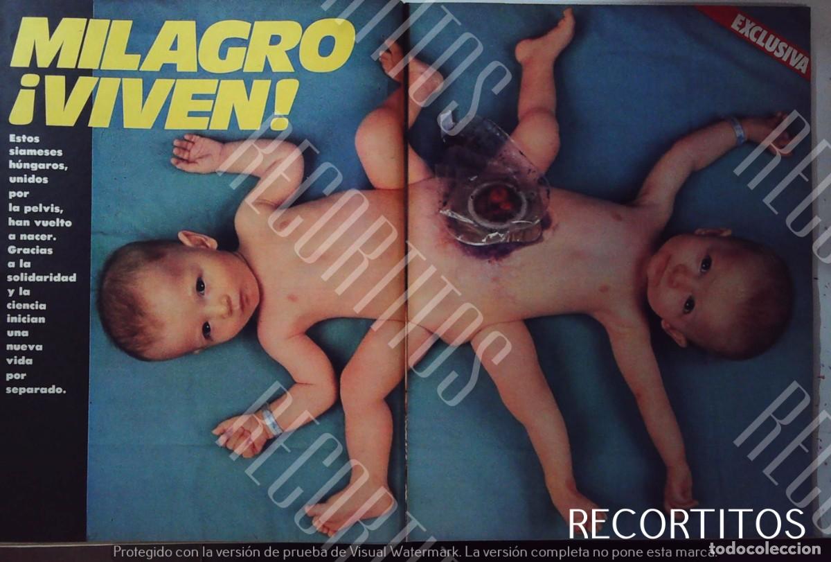 M&uacute;sica de colecci&oacute;n: MELLIZOS SIAMESES MILAGRO - Foto 1