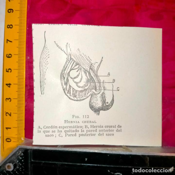 Outros artigos de papel: antiguo grabado medicina enfermedades cuerpo humano salud - HERNIA CRURAL
