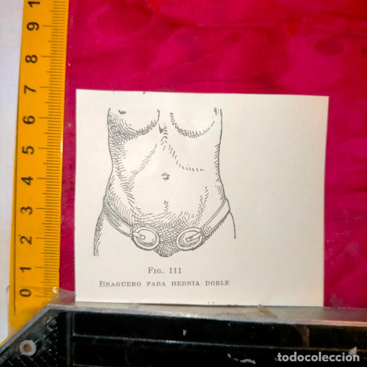 Outros artigos de papel: antiguo grabado medicina enfermedades cuerpo humano salud - BRAGUERO PARA HERNIA DOBLE