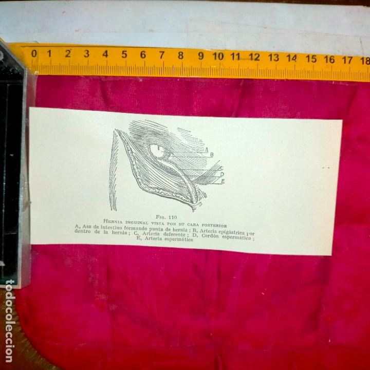 Outros artigos de papel: antiguo grabado medicina enfermedades cuerpo humano salud - HERNIA INGUINAL