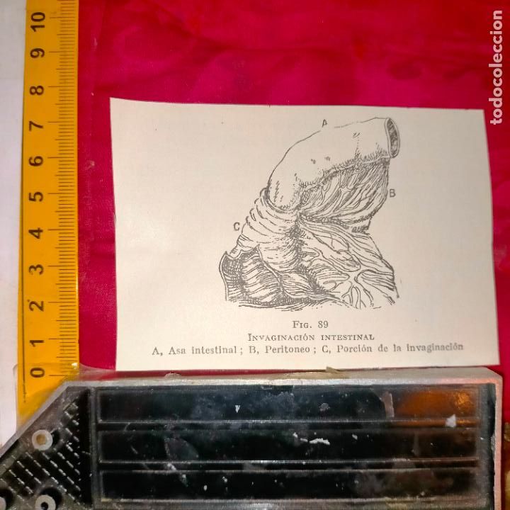 Collectionnisme Papier divers: antiguo grabado medicina enfermedades cuerpo humano salud - INVAGINACION INTESTINAL