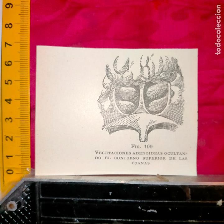 Collectionnisme Papier divers: antiguo grabado medicina enfermedades cuerpo humano salud - VEGETACIONES ADENOIDEAS