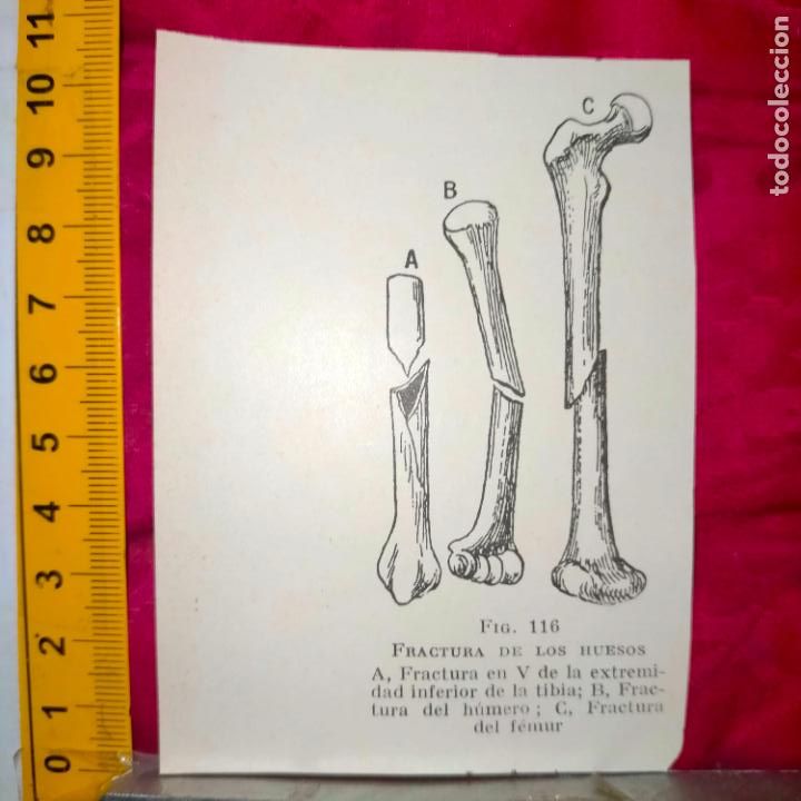 Collectionnisme Papier divers: antiguo grabado medicina enfermedades cuerpo humano salud - FRACTURAS DE HUESOS