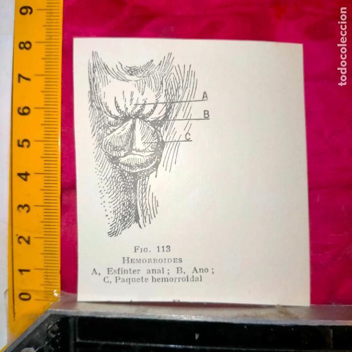 Collectionnisme Papier divers: antiguo grabado medicina enfermedades cuerpo humano salud - HEMORROIDES ANAL