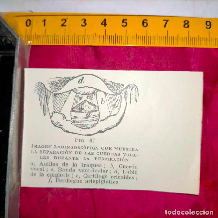 Collectionnisme Papier divers: antiguo grabado medicina enfermedades cuerpo humano salud - IMAGEN LARINGE