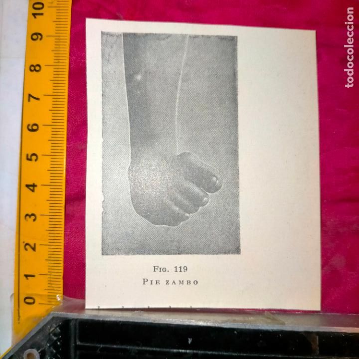 Outros artigos de papel: antiguo grabado medicina enfermedades cuerpo humano salud - PIE ZAMBO