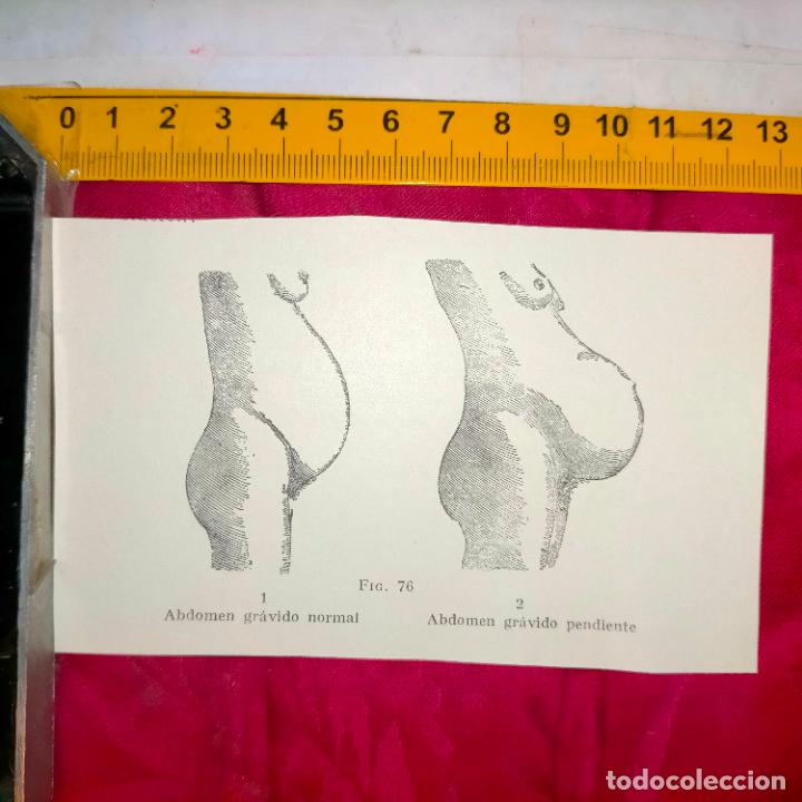 Outros artigos de papel: antiguo grabado medicina enfermedades cuerpo humano salud - ABDOMEN GRAVIDO NORMAL Y PENDIENTE