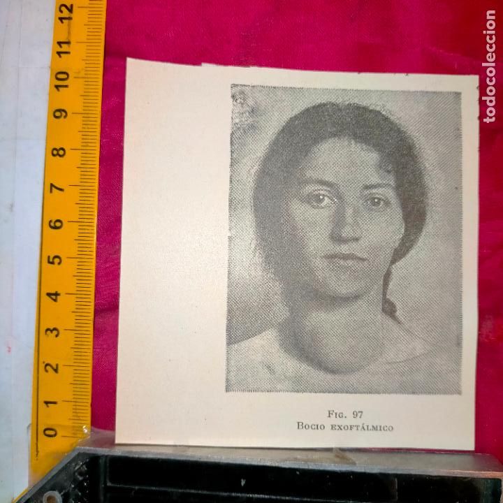 Otros art&iacute;culos de coleccionismo en papel: antiguo grabado medicina enfermedades cuerpo humano salud - BOFIO EXOFTALMICO
