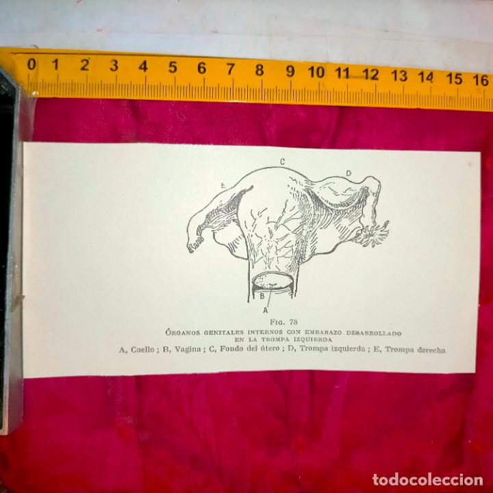 Otros art&iacute;culos de coleccionismo en papel: antiguo grabado medicina enfermedades cuerpo humano salud - ORGANOS GENITALES MUJER TOMPA IZQUIERDA