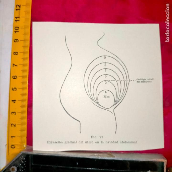 Outros artigos de papel: antiguo grabado medicina enfermedades cuerpo humano salud - EMBARAZO ELEVACION GRADUAL ABDOMINAL