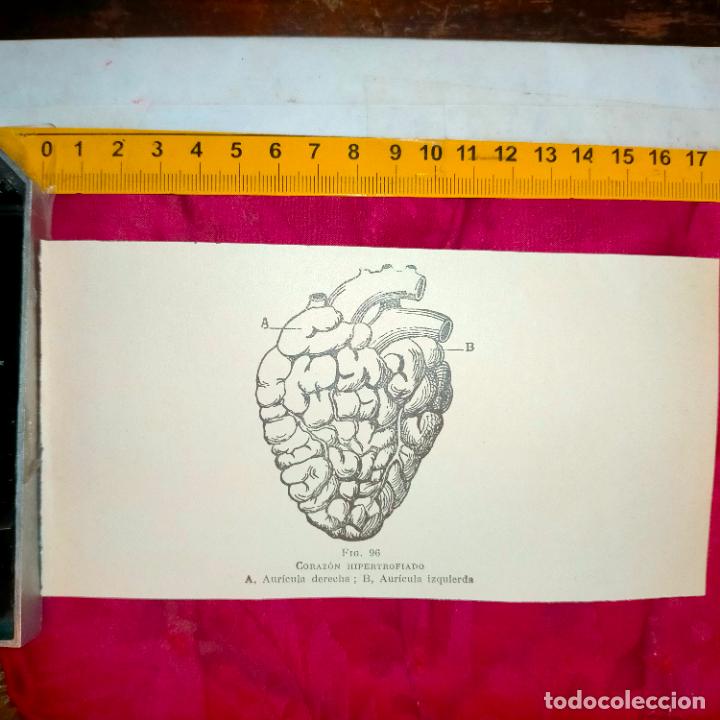 Outros artigos de papel: antiguo grabado medicina enfermedades cuerpo humano salud - CORAZON HIPERTROFIADO