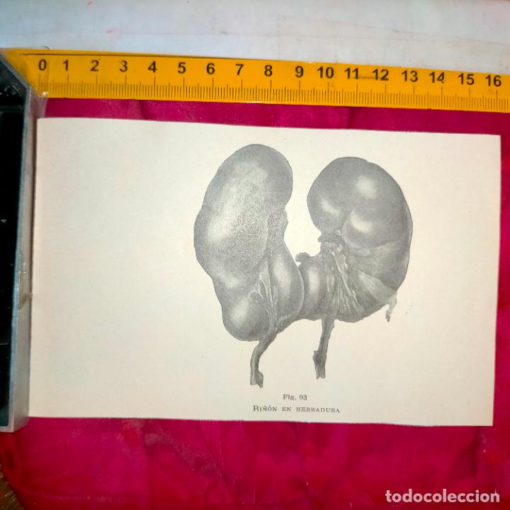 Outros artigos de papel: antiguo grabado medicina enfermedades cuerpo humano salud - RI&Ntilde;ON EN HERRADURA