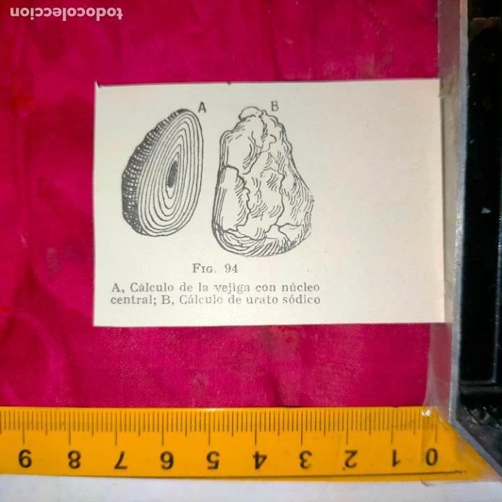 Otros art&iacute;culos de coleccionismo en papel: antiguo grabado medicina enfermedades cuerpo humano salud - CALCULO DE LA VEJIGA