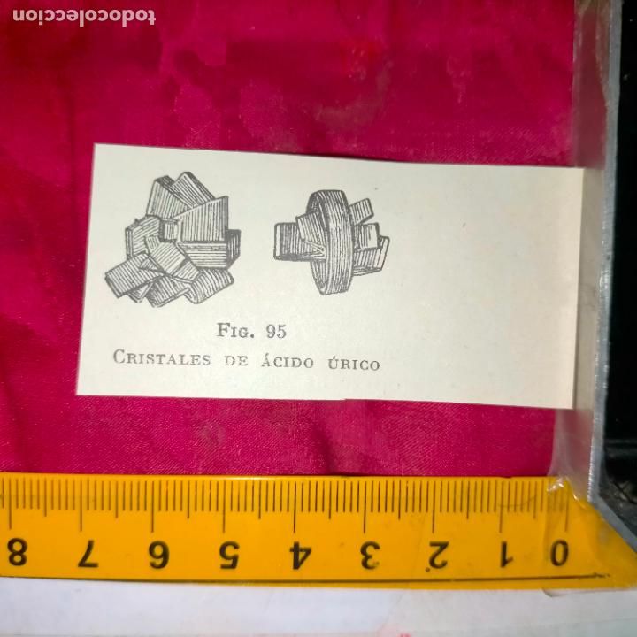 Otros art&iacute;culos de coleccionismo en papel: antiguo grabado medicina enfermedades cuerpo humano salud - CRISTALES DEL ACIDO URICO