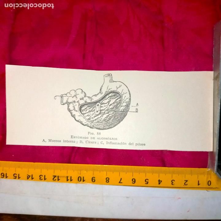 Otros art&iacute;culos de coleccionismo en papel: antiguo grabado medicina enfermedades cuerpo humano salud - ESTOMAGO DE ALCOHOLICO