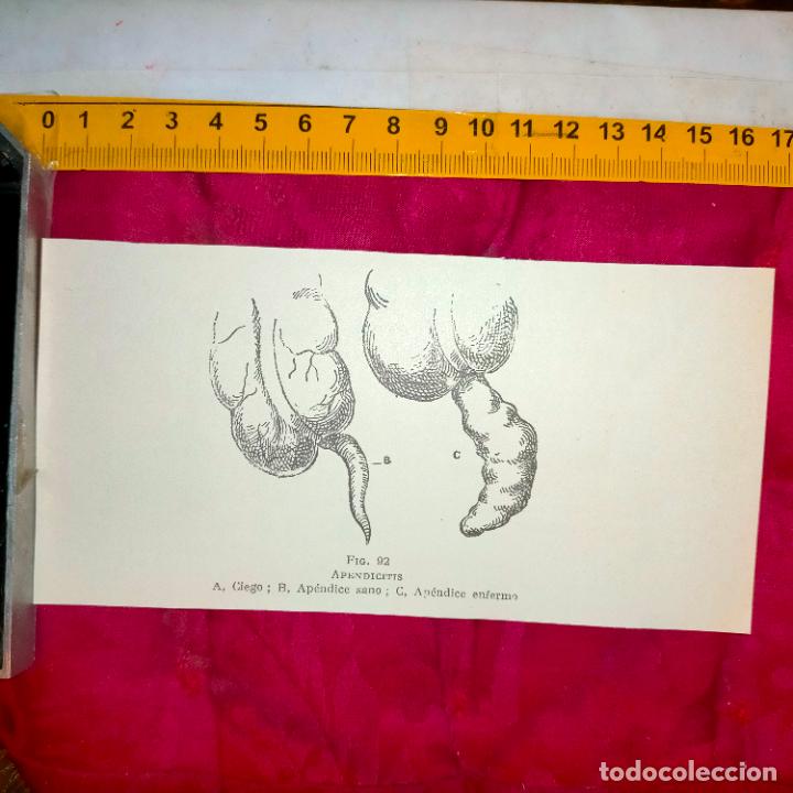 Outros artigos de papel: antiguo grabado medicina enfermedades cuerpo humano salud - APENDICE APENDICITIS