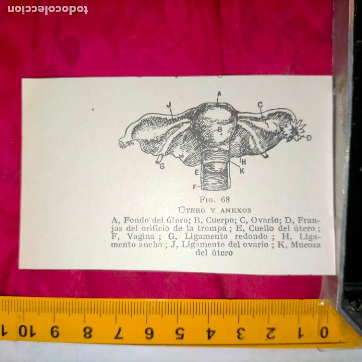 Otros art&iacute;culos de coleccionismo en papel: antiguo grabado medicina enfermedades cuerpo humano salud - UTERO Y ANEXOS