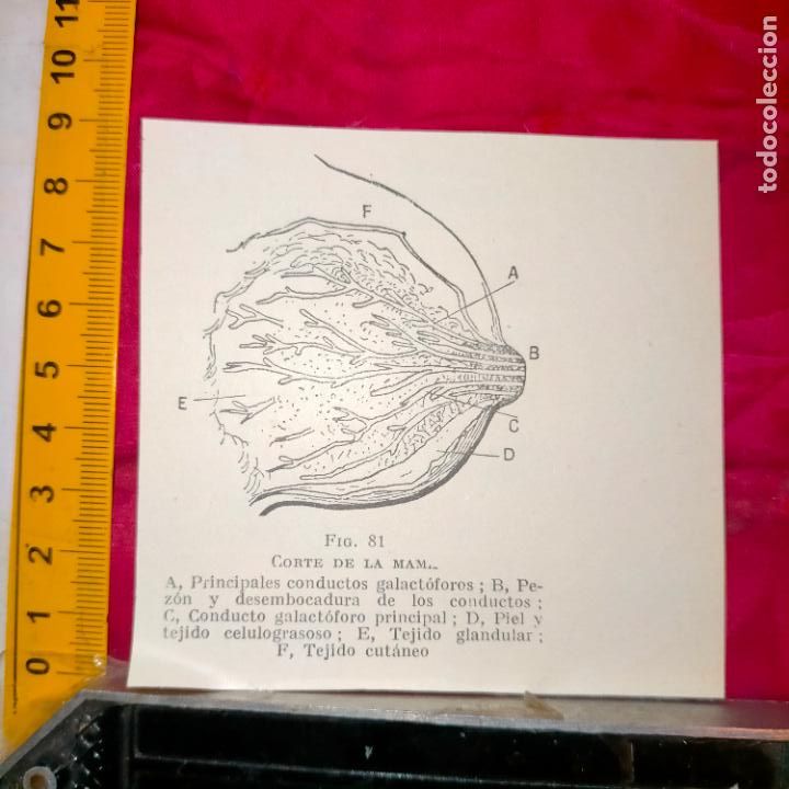 Outros artigos de papel: antiguo grabado medicina enfermedades cuerpo humano salud - PECHO TETA MAMA