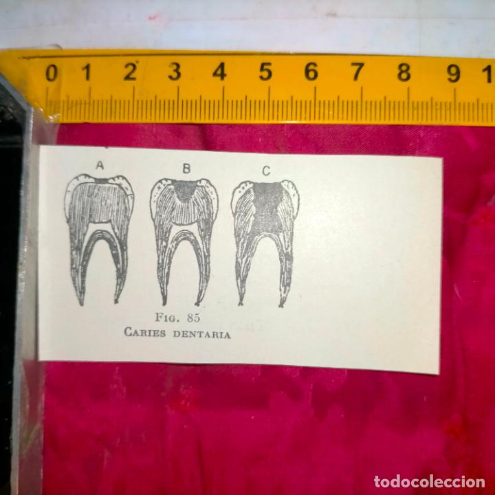 Outros artigos de papel: antiguo grabado medicina enfermedades cuerpo humano salud - CARIES DENTALES DIENTES