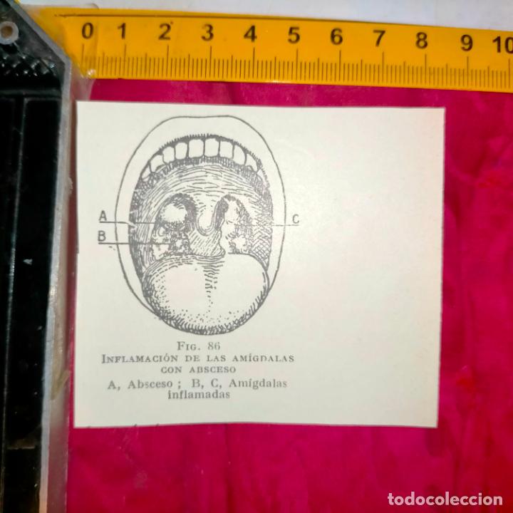 Outros artigos de papel: antiguo grabado medicina enfermedades cuerpo humano salud - BOCA INFLAMACION DE ADMIGDALAS