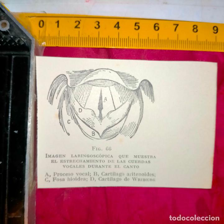 Outros artigos de papel: antiguo grabado medicina enfermedades cuerpo humano salud - CUERDAS VOCALES DURANTE EL CANTO