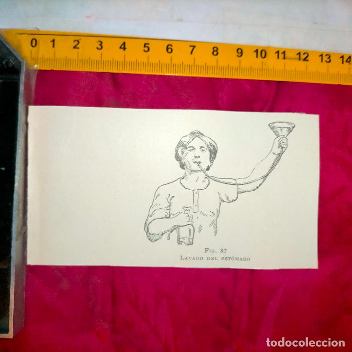 Outros artigos de papel: antiguo grabado medicina enfermedades cuerpo humano salud - LAVADO DE ESTOMAGO