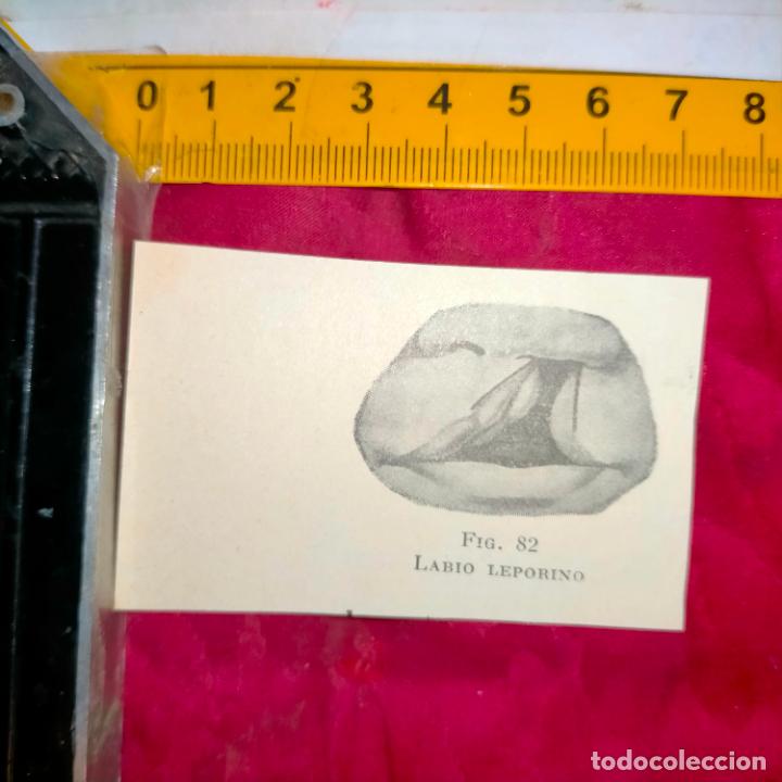 Otros Art&iacute;culos de Coleccionismo en Papel: antiguo grabado medicina enfermedades cuerpo humano salud - BOCA LABIO LEPORINO