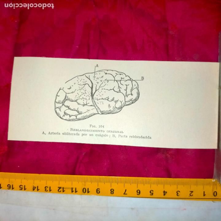 Outros artigos de papel: antiguo grabado medicina enfermedades cuerpo humano salud - CEREBRO REBLANDECIMIENTO CEREBRAL