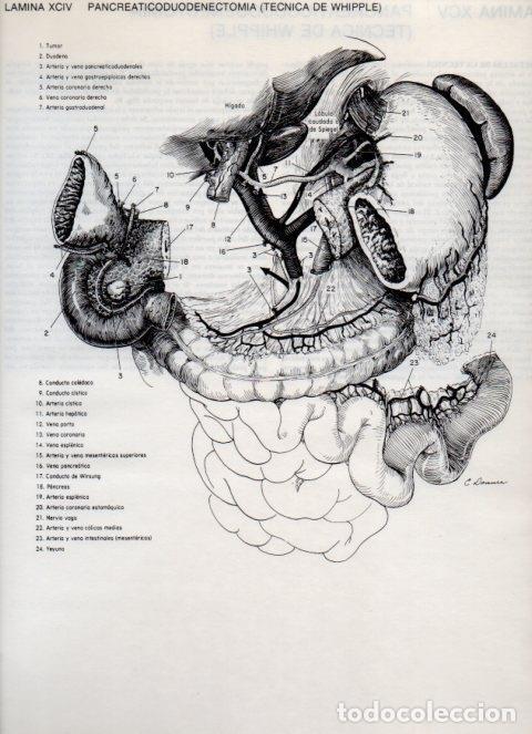 Otros art&iacute;culos de coleccionismo en papel: LAMINA V20155: Pancreaticoduodenectomia, tecnica de Whipple 1 - Dr. Robert M. Zollinger