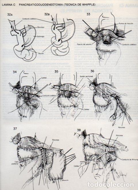 Otros art&iacute;culos de coleccionismo en papel: LAMINA V20161: Pancreaticoduodenectomia, tecnica de Whipple 7 - Dr. Robert M. Zollinger