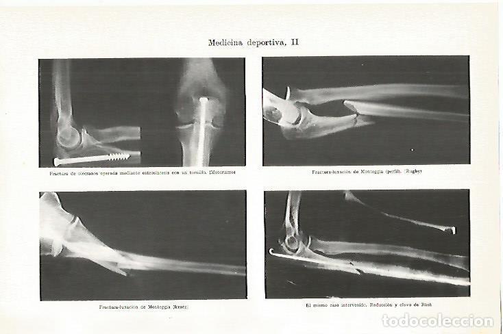 Otros art&iacute;culos de coleccionismo en papel: LAMINA ESPASA 13467: Fracturas en medicina deportiva - Varios
