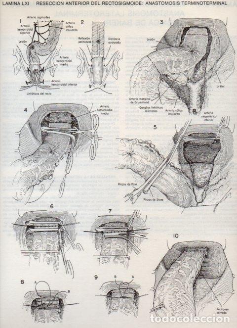 Postais: LAMINA V20122: Reseccion anterior del rectosigmoide: Anastomosis terminoterminal - Dr. Robert M. Zol