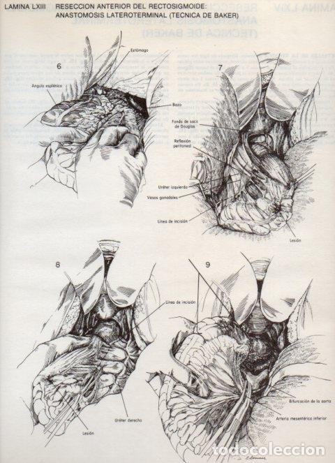 Postcards: LAMINA V20124: Reseccion anterior del rectosigmoide: Anastomosis lateroterminal (tecnica de Baker) 2