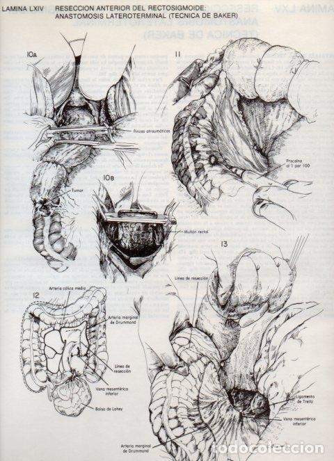 Cartoline: LAMINA V20125: Reseccion anterior del rectosigmoide: Anastomosis lateroterminal (tecnica de Baker) 3