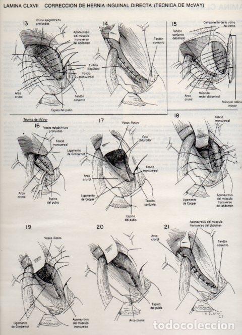 Postkarten: LAMINA V20228: Correccion de hernia inguinal directa, tecnica de Mcvay - Dr. Robert M. Zollinger