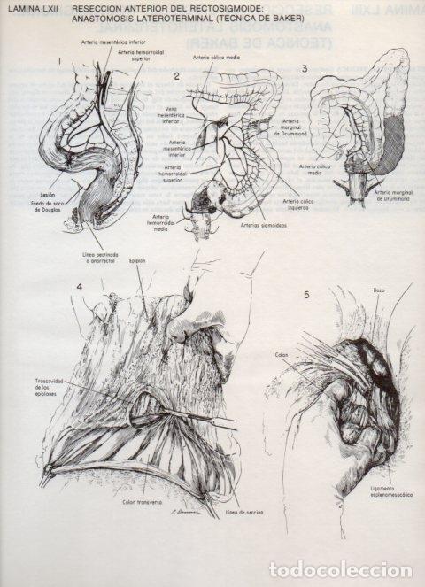 Postais: LAMINA V20123: Reseccion anterior del rectosigmoide: Anastomosis lateroterminal (tecnica de Baker) 1