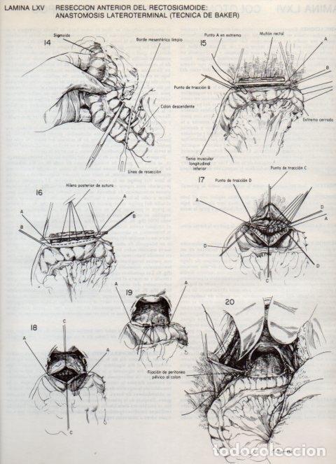 Postais: LAMINA V20126: Reseccion anterior del rectosigmoide: Anastomosis lateroterminal (tecnica de Baker) 4