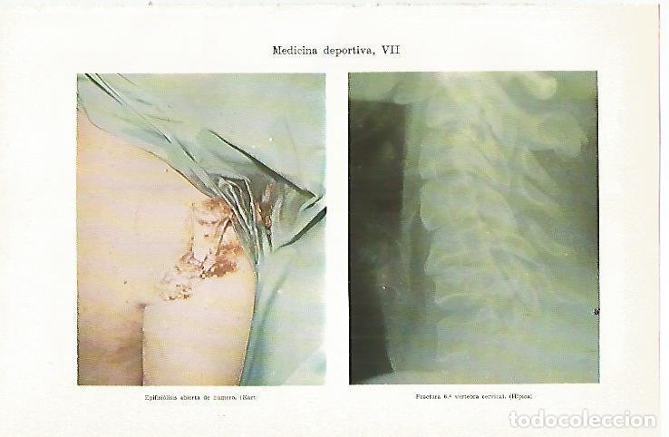 Cartoline: LAMINA ESPASA 13470: Epifisiolisis abierta de humero - Varios